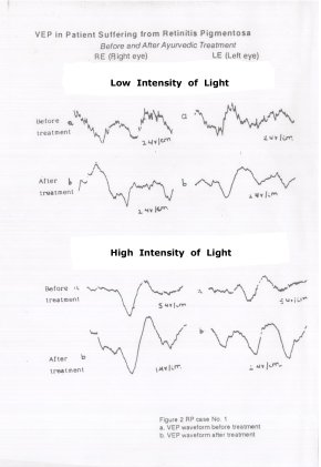 Figure 4  V.E.P  in RP